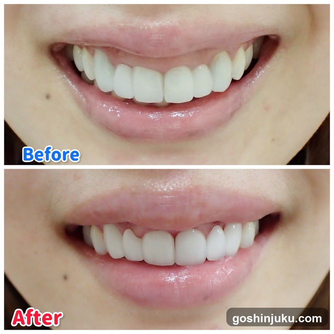 Before and After Teeth Whitening Comparison