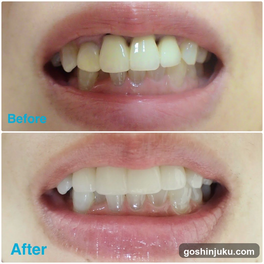 Before and After Teeth Whitening