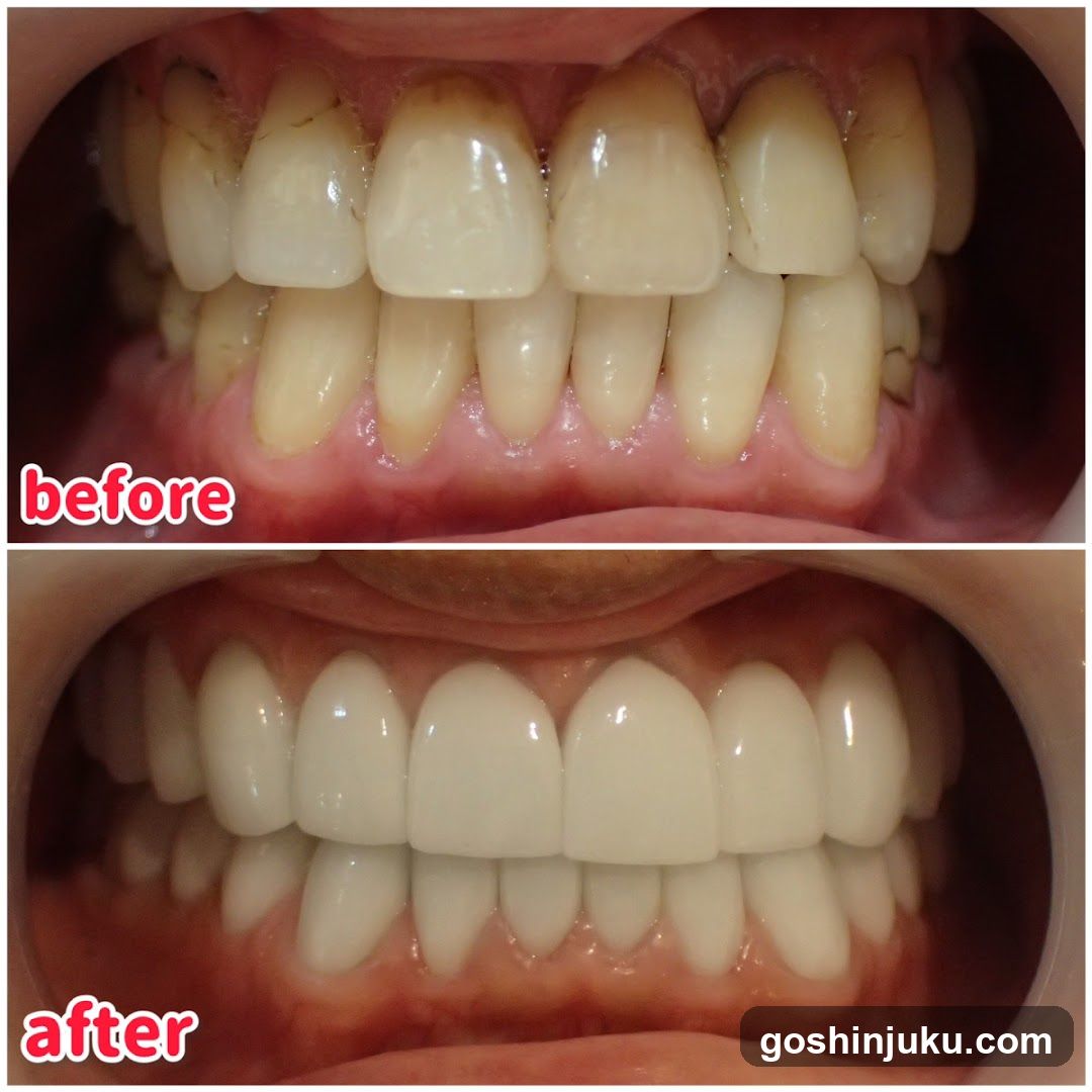 Before and After Teeth Whitening