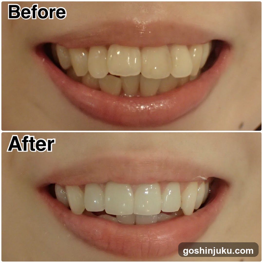 Before and After Smile Comparison