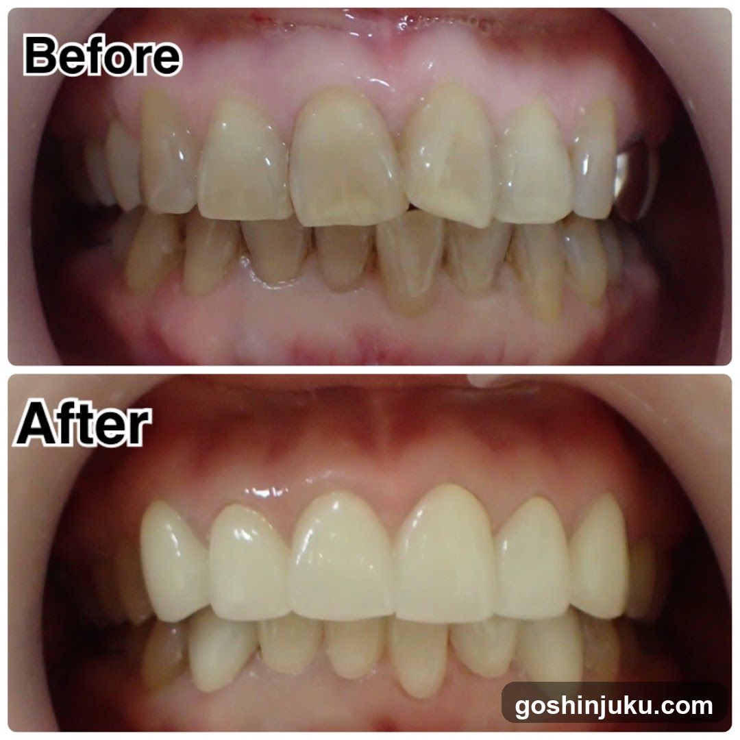 Before and After Teeth Whitening