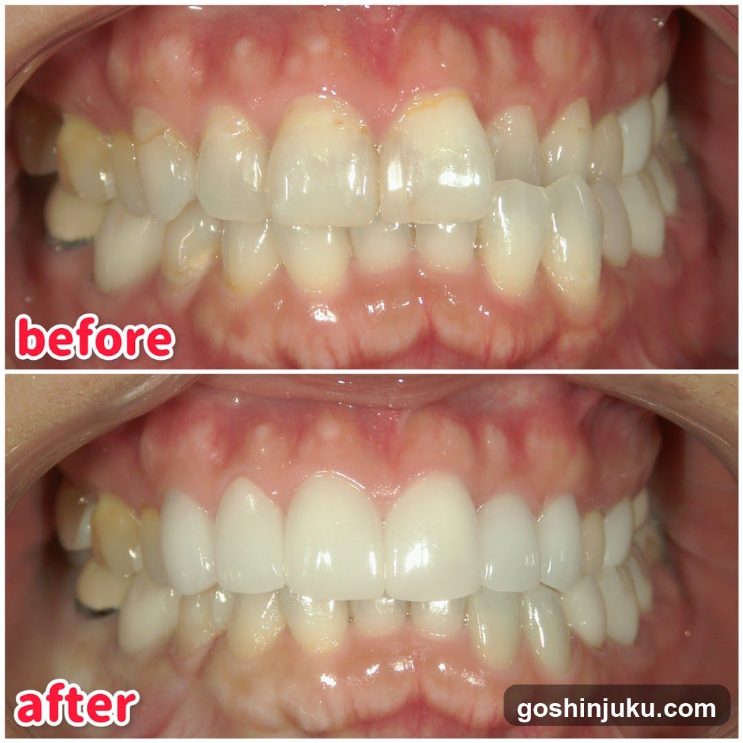 Before and After Teeth Whitening