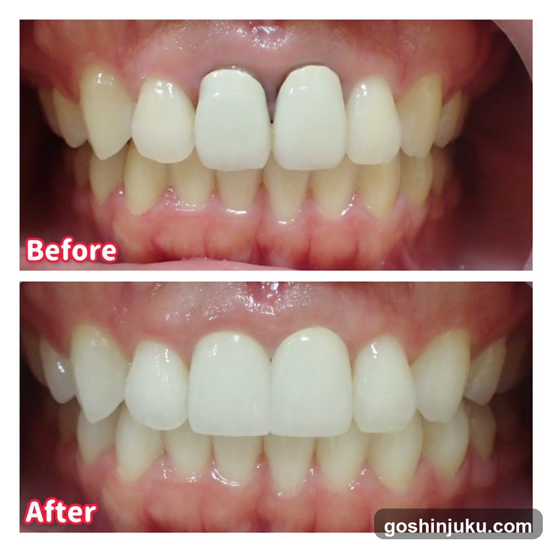 Before and After Teeth Whitening