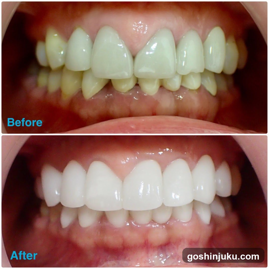 Before and After Teeth Whitening